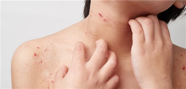 Ein Kind kratzt sich am Hals. Auf seiner Haut sieht man rote aufgekratze Stellen. 