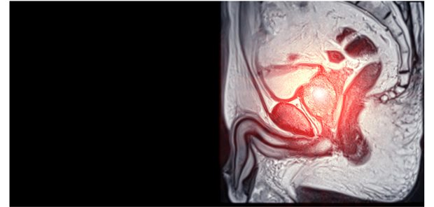 PARPi plus ARPi: Nur bei BRCA-Mutation oder auch für Patienten ohne Mutation?