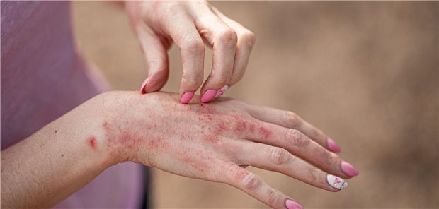 Bifonazol: Antimykotikum mit antientzündlicher Wirkung