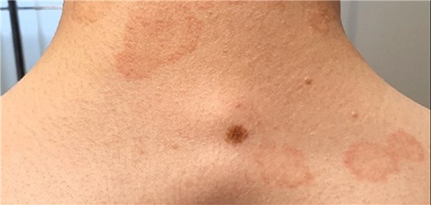 Die Bedeutung von Bifonazol in der Therapie der Tinea capitis Die Bedeutung von Bifonazol in der Therapie der Tinea capitis