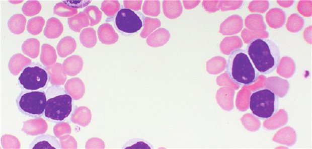 Acalabrutinib: TTNT-Update der AMPLIFY-Studie und RWE-Daten