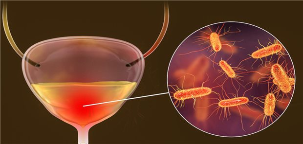 Therapie bei unkomplizierter Zystitis