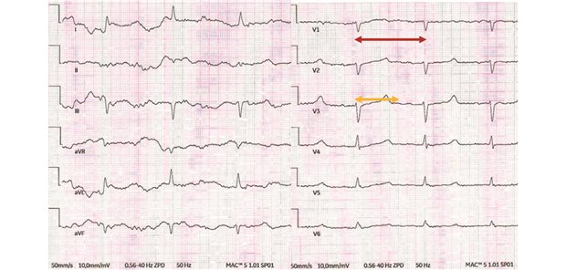 Auffälliges EKG: Hypokalzämie