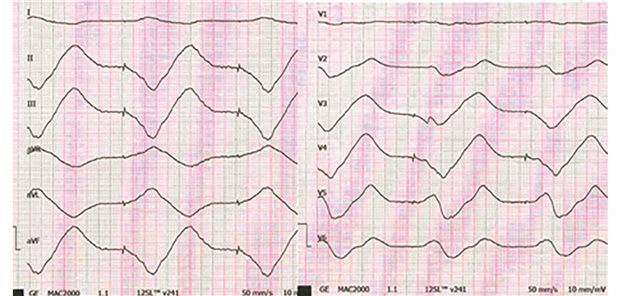 Auffälliges EKG: Hyperkaliämie