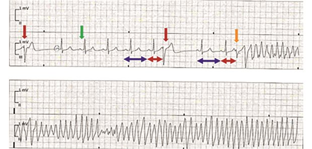 Auffälliges EKG: Torsade-de-pointes-Tachykardie (TdP)