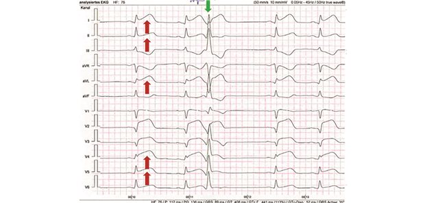 Auffälliges EKG: Vorderwandinfarkt