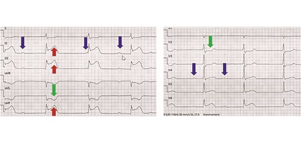 Auffälliges EKG: Hinterwandinfarkt und AV-Block III