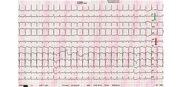 Auffälliges EKG: Vorhofflattern