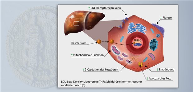 Erste orale Therapie bei nicht zirrhotischer MASH mit Fibrose