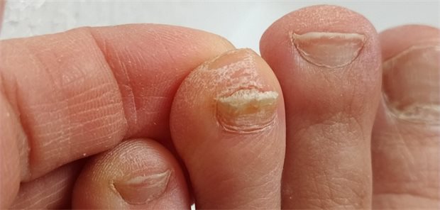 Thailandpilz, Tierkontakt & Nagelpilz