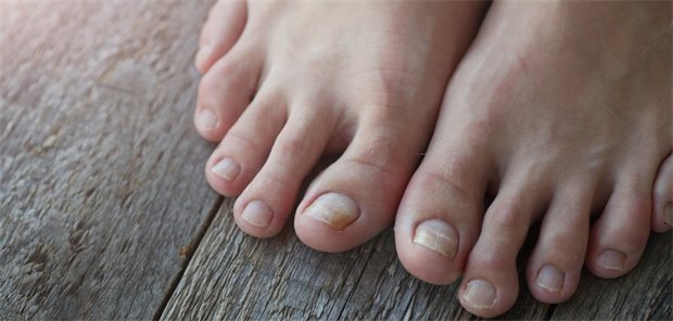 StiWa empfiehlt wenige Nagelpilz-Mittel – Canesten® Extra dabei