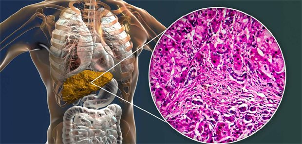Primär Biliäre Cholangitis: therapeutisches Potenzial der PPAR-Aktivierung