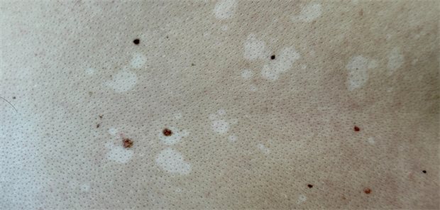 Pityriasis versicolor