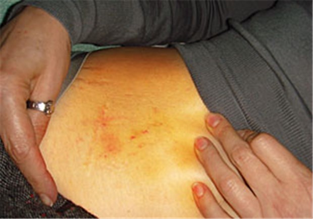 Charité-Ärzte fordern: Lasst Julia Timoschenko ausreisen Bildauschnitt mit Hämatomen an Julia Timoschenkos Bauch.