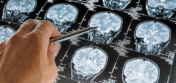 Neues in Sachen Diagnostik und Therapie bei Alzheimer Bildgebende Verfahren sind ein fester Bestandteil der Basisdiagnostik mit dem Ziel, die Ätiologie der Demenz zu klären.