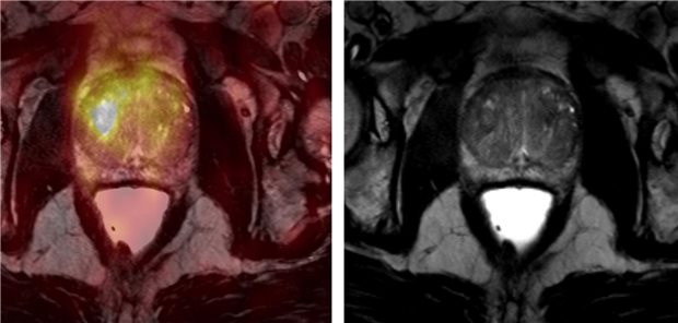 Bildgebung eines Prostatakarzinoms bei einem 55-jährigen Patienten. Moderne Bilddaten erlauben maßgeschneiderte Therapien, wie beim Kongress der Radioonkologen deutlich wurde.