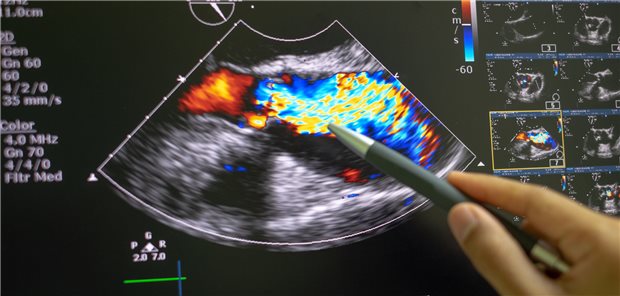 Bildgebung mit Echokardiografie bei Aortenstenose: Betroffene unter oralen Antikoagulanzien sind besonders gefährdet.
