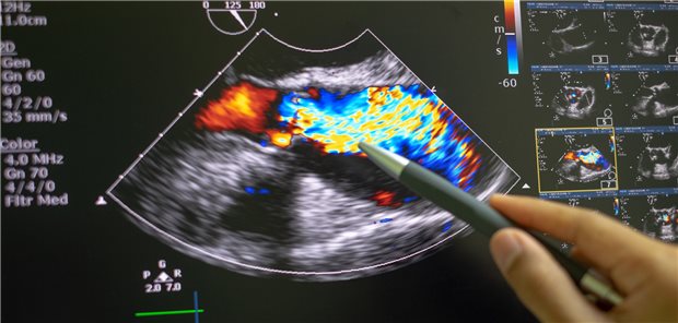 Bildgebung mit Echokardiografie bei Aortenstenose: Die Achilles-Ferse der Methode ist die Variabilität bei der Interpretation.
