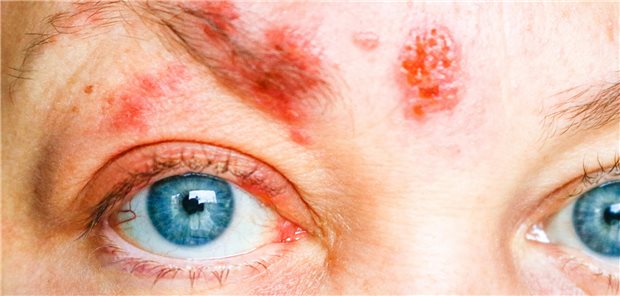 Binnen 56 Tagen nach der Impfung mit rekombinantem Zoster-Vakzine betrug die Inzidenz von Herpes zoster ophthalmicus Rezidiven bei den 3.646 geimpften Teilnehmerinnen und Teilnehmern 37,7 pro 1.000 Personen pro Jahr. Bei 12.762 Nicht-Geimpften waren es hingegen nur 26,2 HZO-Rezidive pro 1.000 Patientenjahre. Das Risiko eines HZO-Rezidivs war also nach Impfung um 64 Prozent erhöht.
