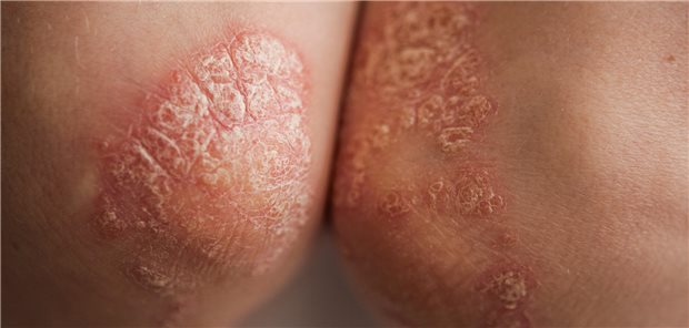 Große rote, entzündete, schuppige Hautveränderungen aufgrund von Psoriasis an den Ellenbogen.