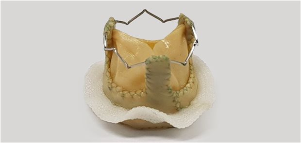 Biologische Herzklappe mit Metallgerüst: Die Bioprothese wird entweder aus Aortenklappen von Schweinen oder aus Herzbeutelgewebe von Rindern hergestellt.