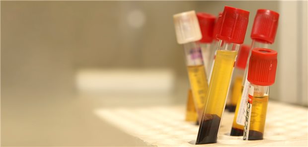 Biomarkertests könnten in der onkologischen Diagnostik und Versorgung europaweit zu immensen Einsparungen führen.