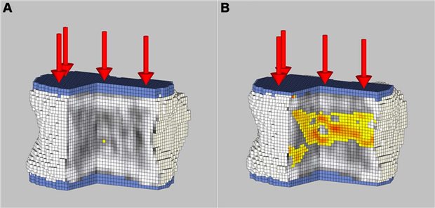 Biomechanische Analyse einer Nicht-Kontrast-CT des L1-Wirbels bei einer 18-jährigen Frau mit schwerer Adipositas vor einer Sleeve-Gastrektomie.