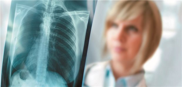 Bis zu 80 Prozent der Patienten mit systemischer Sklerose bekommen eine interstitielle Lungenerkrankung. (Symbolbild)