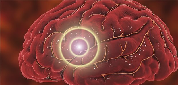 Bis zu ein Prozent aller Schlaganfälle gehen auf Zerebralvenenthrombosen zurück.