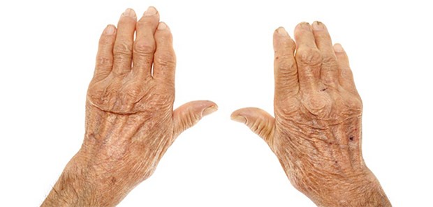 Patienten müssen zu lange auf Erstkontakt warten Bis zum Erstkontakt mit einem internistischen Rheumatologen warteten Patienten fast ein ganzes Jahr.