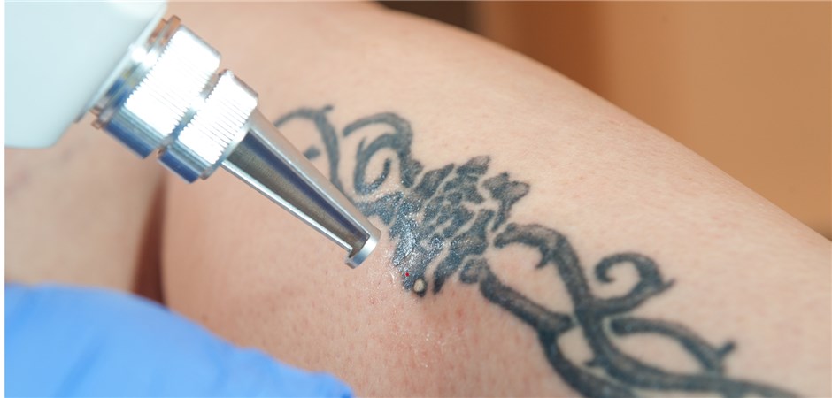 Nur Ärzte dürfen wohl bald Tattoos weglasern
