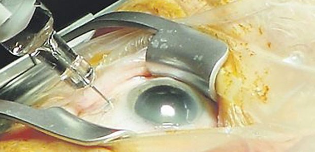 Aufsicht drückt beide Augen zu Bisher keine EBM-Leistung: intravitreale Injektion.
