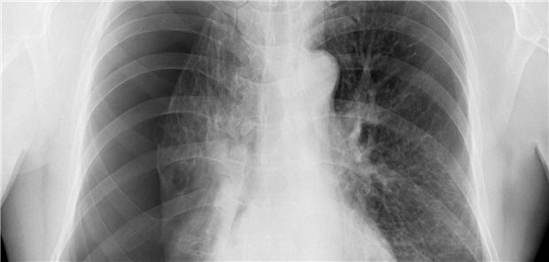 Röntgenaufnahme des Brustkorbs eines Patienten mit einem Pneumothorax.