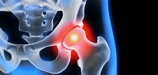 Bislang werden bei älteren Patienten zementierte Prothesen als die bessere Wahl angesehen,