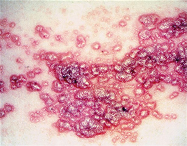 Gürtelrose erhöht das GBS-Risiko um das 20-fache Bläschen bei Herpes zoster: die Erkrankung erhöht das GBS-Risiko offenbar um das 20-fache.