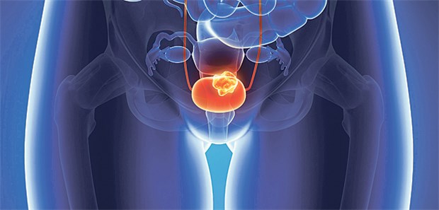 Therapie-Durchbruch bei Blasenkrebs? Blasenkrebs: Haben Betroffene bereits Metastasen, ist die Chemotherapie wenig wirksam