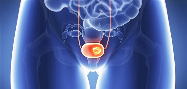 Blasenkrebs: Nach den Ergebnissen einer Phase-II-Studie zeichnet sich eine neue Option in der Zweitlinie an.
