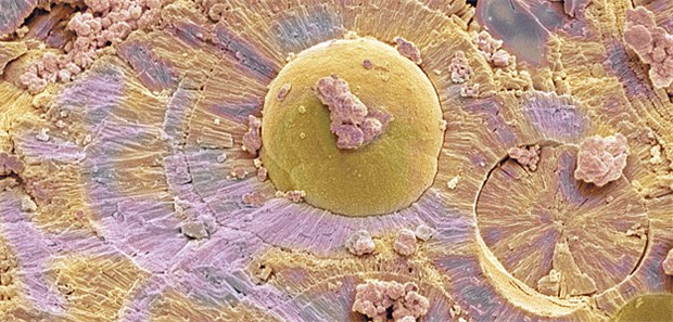 Blasensteine: Steinleiden waren der häufigste Grund für die asymptomatische Mikrohämaturie.
