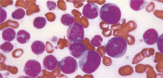 Blastenkrise bei chronischer myeloischer Leukämie (CML).