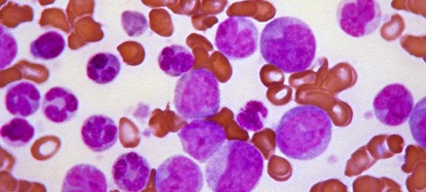 Blastenkrise einer Chronisch Myeloischen Leukämie (CML).