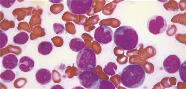 Blastenkrise einer chronisch myeloischen Leukämie (CML).