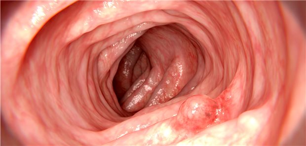 Blick auf den Darm in der Koloskopie: Besonders bei Unter-50-Jährigen mit Eisenmangelanämie oder Hämatochezie angeraten.