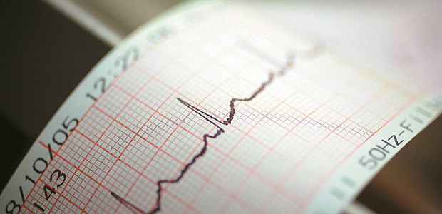 Vorhofflimmern geht auf Kognition Blick aufs EKG: Wenn der Vorhof flimmert, leidet die Kognition.