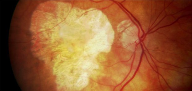 Blick ins Auge eines Patienten mit der trockenen Form der altersbedingten Makuladegeneration.