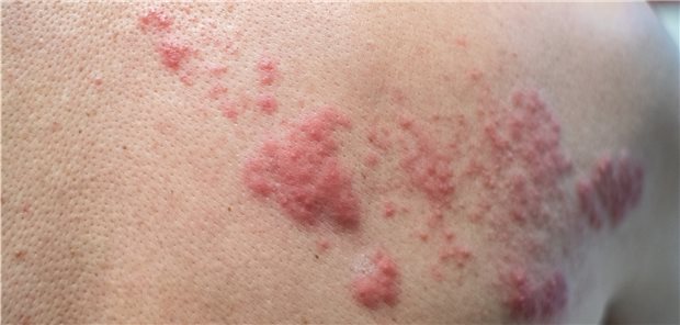 Sehr hoher Schutz vor Herpes zoster durch die Impfung Blickdiagnose: klinisches Bild mit typischen Effloreszenzen bei Herpes zoster.