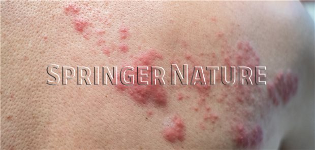 ZosterImpfung schützt langfristig