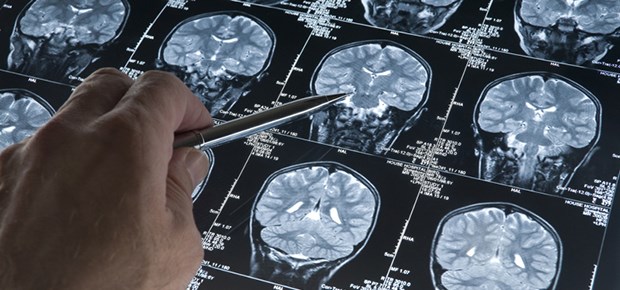 Neurologen gewinnen Zeit Blicks in Hirn: Die Frühdiagnostik hilft immer besser bei Demenzerkrankungen.
