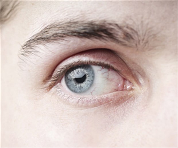 Parkinson? Schau mir in die Augen! Bloß nicht zittern.