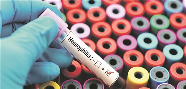 Wann ist es ethisch vertretbar, eine Gentherapie einzusetzen? Blut eines Hämophilie-Patienten – eine Genveränderung kann neue Therapieansätze eröffnen.