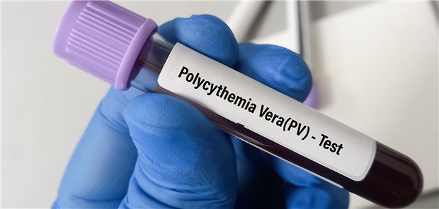 Blut für den Test auf Polcythaemia vera.